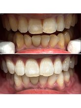 エピシアドットエヌ(epicia.N)/短期間で白い歯を