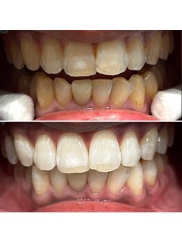 エピシアドットエヌ(epicia.N)/短期間で白い歯を