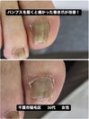 巻き爪の痛みから解放され笑顔に