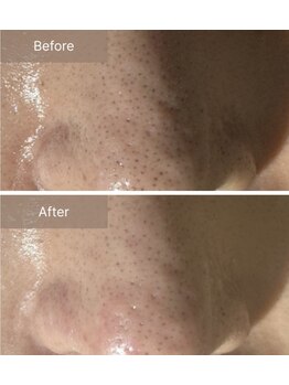 エミルカ 千葉店(EMILUCA)/ハーブピーリング顔/毛穴ケア