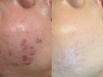 モナートドゥ(Monartdeux)/肌質改善☆ハーブピーリング