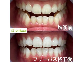 ルブラン 奈良店(Le Blanc)/歯石取りとホワイトニングで