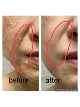 エムローズ(M.rose)/3D小顔リフト