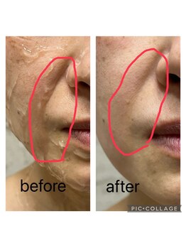 エムローズ(M.rose)/3D小顔リフト