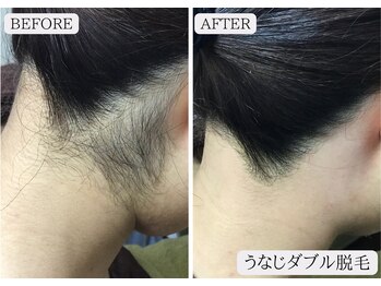 ルミア 函館店(LuMia)/うなじ脱毛にはワックス脱毛が◎