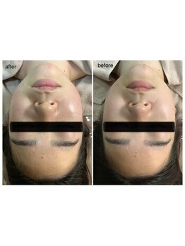 エスティ 京都店/整顔before/after