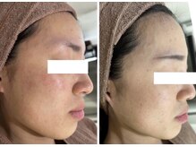 ホワイトアクア 岐阜店(WHITE AQUA)/ハーブピーリング/岐阜/ニキビ