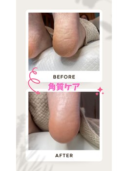 ドクターネイル爪革命 恵庭店/角質ケア