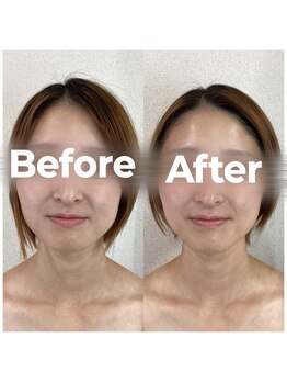 レオ(LEO)/Before→After