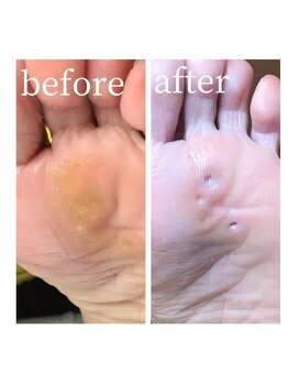 ドクターネイル爪革命 岡山店/魚の目ケア