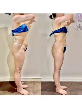 カルナ(CARNA)/【痩身】セルライトゼロ2