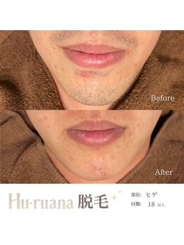 フルアナ(Hu ruana)/脱毛