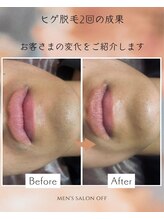 オフ(off)/ヒゲ脱毛