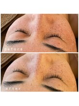 メナードフェイシャルサロン 岐阜茜部/ホワイトニングパック