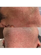 ミーエイト(Mii∞)/《ポップアップ・脱毛効果》