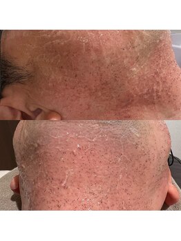 ミーエイト(Mii∞)/《ポップアップ・脱毛効果》