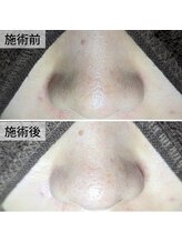 美鼻ラボ 押上 曳舟/角栓顔出しもお任せ！