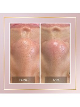 リシェス(Richesse)/黒ずみ改善☆初回¥9990