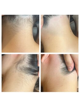 ブラジリアンワックス脱毛専門店 ヴァージンワックス 大宮店(Virgin Wax)/【うなじ】ビフォーアフター