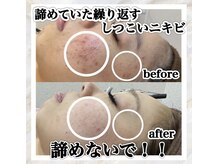 エステティック レイビス 八戸店(RAYVIS)/ニキビケア