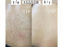 22クラレ(22curare)/背中ハーブピーリング☆