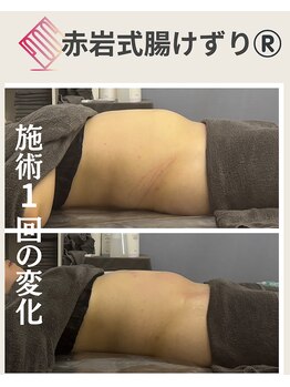 リア(Lia)/30代女性施術1回の効果