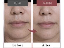 フルリール/【全顔脱毛】