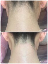 ブラジリアンワックス専門店 アンジー(ANGIE)/うなじ