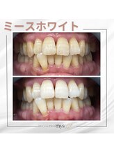 ミースホワイトニング(mys whitening)/ビフォーアフター【歯科提携】