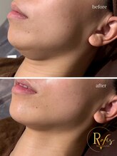 ラヴィス(RAVIS)/韓国肌管理ラミネーションピール