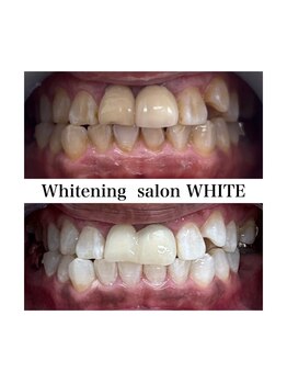 ホワイトニングサロン ホワイト 津山店(WHITE)/ビフォーアフター
