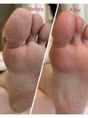 足裏角質ケア