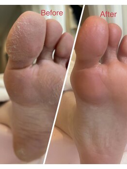 足裏角質ケア