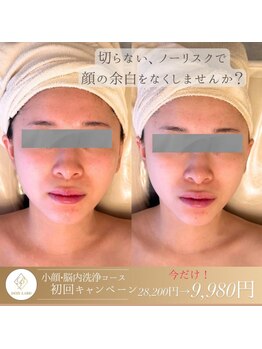 ボインラボ(Boin Labo)の写真/フェイスラインスッキリ！たった一回でこの効果☆理想の小顔を叶えます！