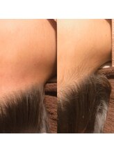 レガリア(LEGAREA)/うなじ脱毛