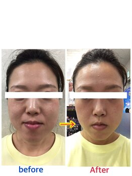 サロン ド ベトリー(Salon de Betory)/40代女性 むくみスッキリ小顔に