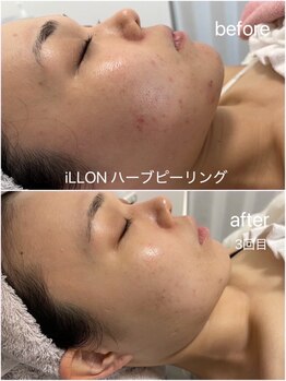 リリラース(Lililas)/