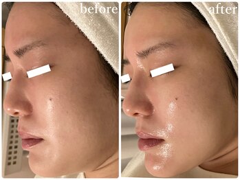 リリィブラン(Lily branc)/毛穴ニキビケア/小顔/美白