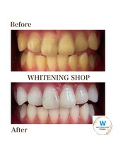 ホワイトニングショップ 小山店/【ビフォーアフター】