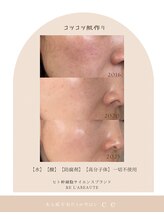 シャルム エスボーテ(charme Esbeaute)/ハーブピーリング