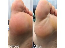 ネイルサロン アニーアンドジーノ(NAIL SALON Annie&Gino)/この夏オススメ角質ケア!!