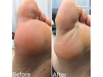 ネイルサロン アニーアンドジーノ(NAIL SALON Annie&Gino)/この夏オススメ角質ケア!!