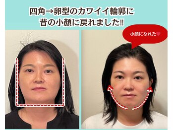 ピュアハリ/沖縄美容鍼 効果