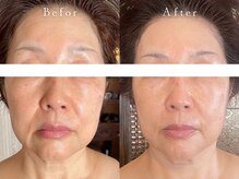 サロン アイプラス(salon i plus)/たるみ/ほうれい線