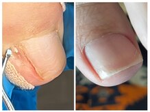 フレッシュフット(FreshFoot)/実績多数★トラブルネイル症例