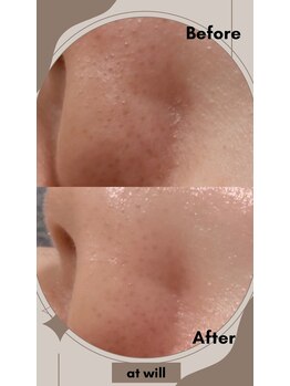 アットウィル 志木店(at will)/毛穴洗浄BeforeAfter