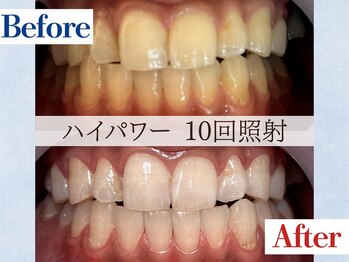 LBSホワイトニング 吉祥寺店/ホワイトニングビフォーアフター