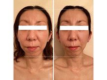 美人バスト 豊橋店/◇小顔症例◇　【フェイシャル】