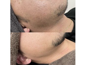 カルディエ(Cardie)/ひげ脱毛　ビフォーアフター