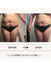 サンテボーテ(Sante Beaute)/ぽっこりお腹がきえた！